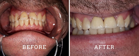 Bonding case 2 before after