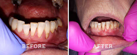 Gum grafting before after case 1