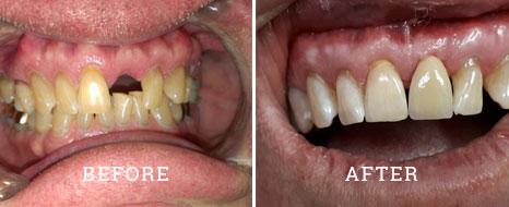 Implant before after