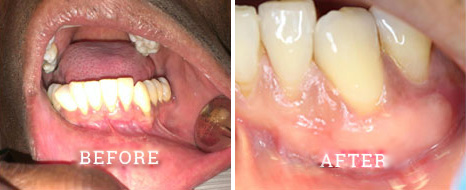Gum grafting before after