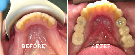 Implant case 2 before after