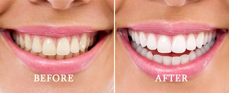 Teeth whitening patient results in Alliston ON