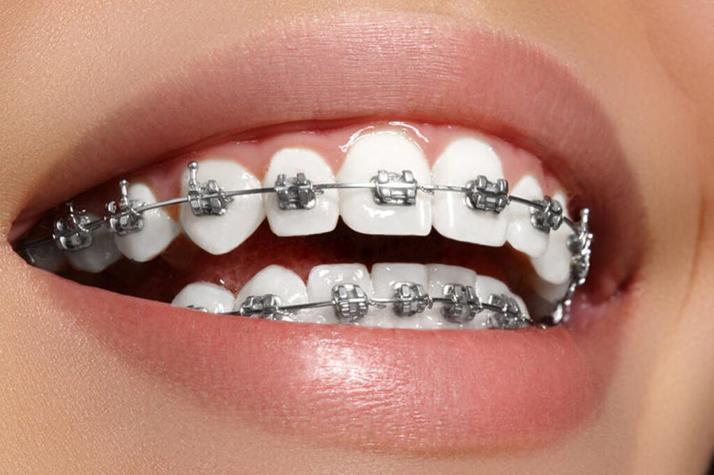 Dental braces